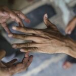 Myths About Leprosy